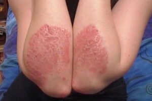Eczema