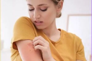 Hives